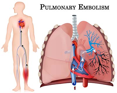 Acute Pulmonary Embolism - Standard Treatment Guidelines