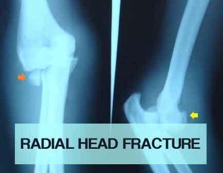 Radial Head Fracture - Standard Treatment Guidelines