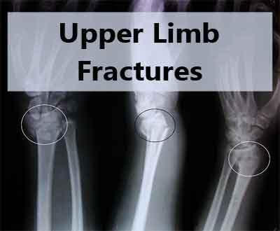 Upper Limb Fractures: Fracture of both bones forearm in adults - Standard Treatment Guidelines