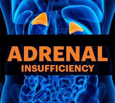 Primary adrenal insufficiency: Endocrine Society practice guidelines