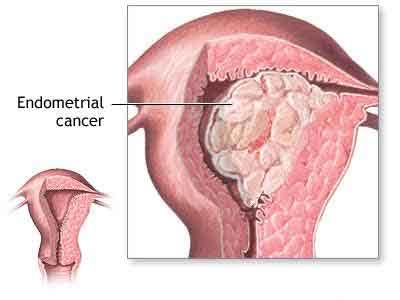Postmenopausal bleeding not a sign of  endometrial cancer in most women