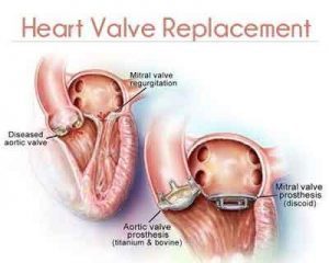 Smallest sized replacement heart valve approved in the world