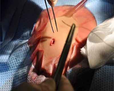 Lucknow: RML Surgeons perform bloodless Surgery, remove gall bladder tumour