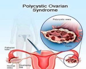 Two years, multiple doctors often needed to diagnose polycystic ovary syndrome, study shows