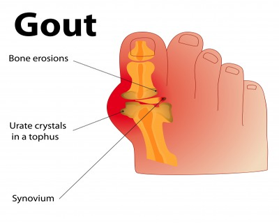 Allopurinol dose escalation unlikely to improve survival in gout