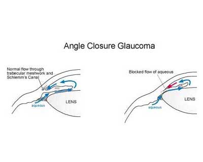 Angle Closure Disease - Standard Treatment Guidelines