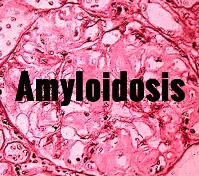 New Research yields hope for amyloidosis