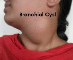 Branchial Cyst - Standard Treatment Guidelines