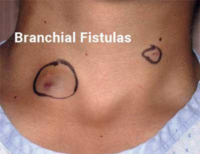 Branchial Fistulas - Standard Treatment Guidelines