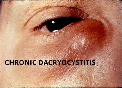 Chronic Dacryocystitis - Standard Treatment Guidelines