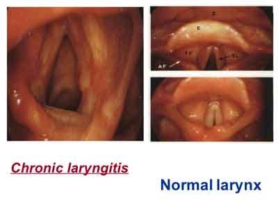 Chronic Laryngitis - GOI Standard Treatment Guidelines