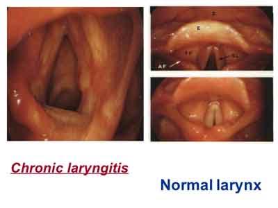 acute laryngitis