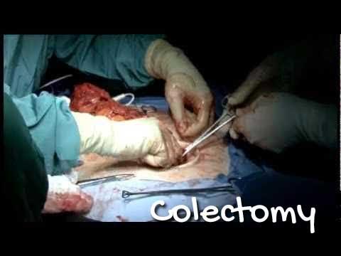 Colectomy - Standard Treatment Guidelines