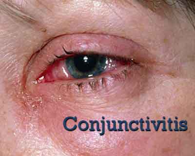 Conjunctivitis- Standard Treatment Guidelines