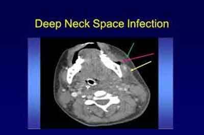 Deep Neck Space Infections