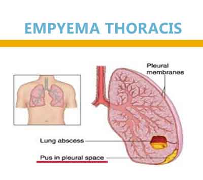 Empyema Thoracis in children : Govt. of India Guideline