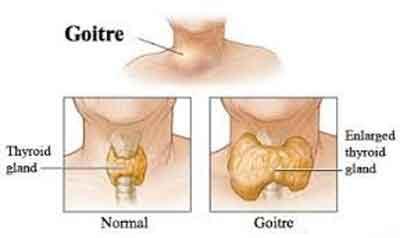 Goitre - Standard Treatment Guidelines