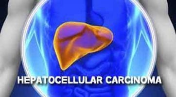 Liver Cancer Or Hepatocellular Carcinoma (HCC) - Standard Treatment Guidelines