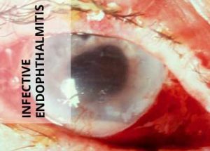 Early surgical intervention beneficial in Nocardia infection following intraocular surgery