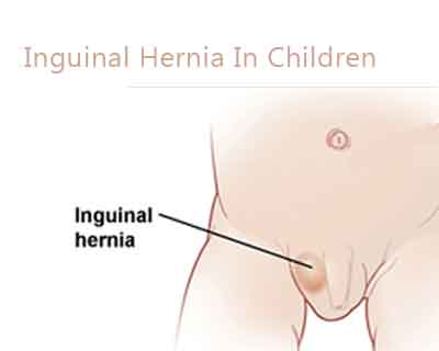 Congenital Inguinal Hernia