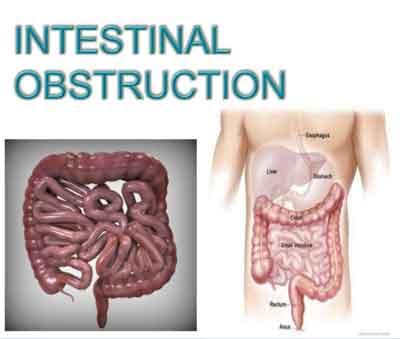 Intestinal Obstruction - Standard Treatment Guidelines