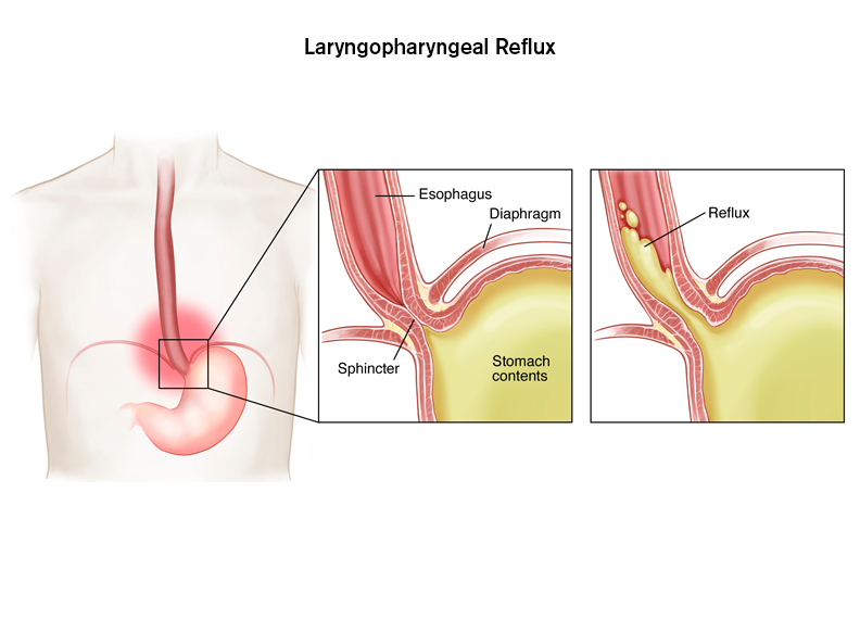 Goi Standard Treatment Guidelines For Laryngopharyngeal Reflux Lpr