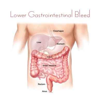 Lower Gastrointestinal Bleed - Standard Treatment Guidelines