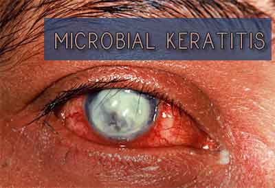 bacterial keratitis symptoms