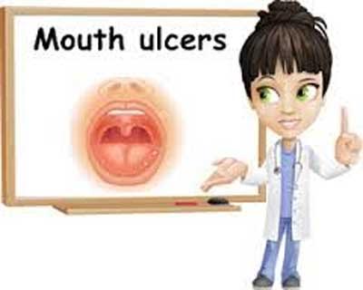 Mouth Ulcers - Standard Treatment Guidelines