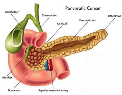 Diagnosis and management of Pancreatic Carcinoma -  New Standard Treatment Guidelines