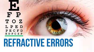 Refractive Errors - Standard Treatment Guidelines