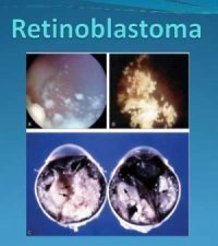 Retinoblastoma:  Standard Treatment Guidelines