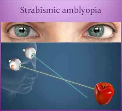 Strabismus and amblyopia:  Standard Treatment Guidelines