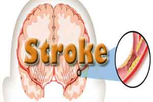 India urged to take better initiatives at stroke management