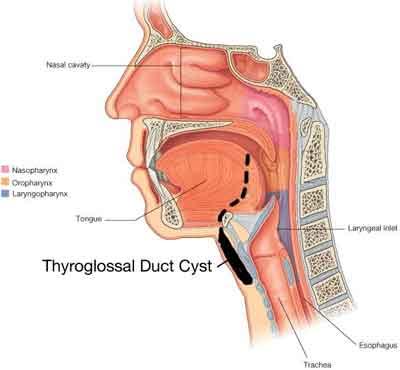 Thyroglossal Duct Cyst And Fistula - Standard Treatment Guidelines ...