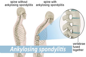 Ixekizumab shows promise in resistant ankylosing spondylitis