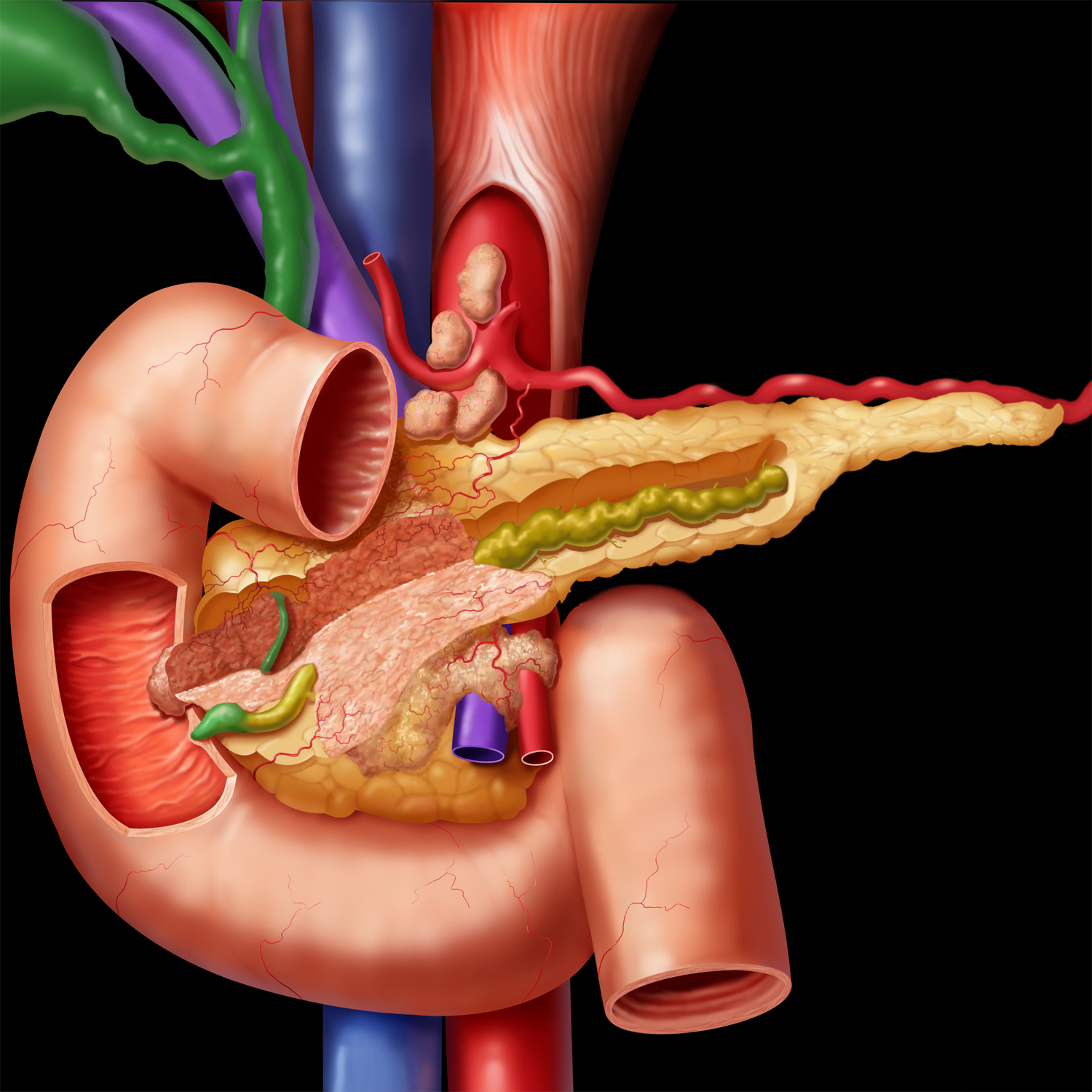 Efficacy of pancreatic enzyme replacement therapy in chronic pancreatitis:meta-analysis