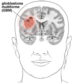 New treatment for Glioblastoma multiforme