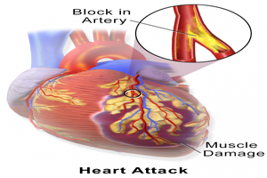 New Blood test may predict coronary artery blockage and heart attack risk