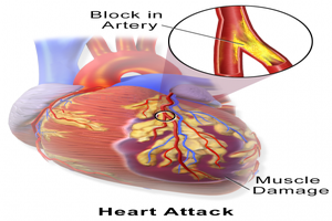 More than 17 lakh Indians getting heart attack did not get right treatment : CSI NIC