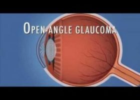 New  Implant to reduce IOP in Glaucoma