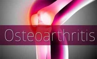 Cartilage degeneration algorithm for prediction of progression of osteoarthritis
