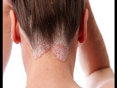 Subcutaneous methotrexate outcome in patients with psoriasis: Lancet Study