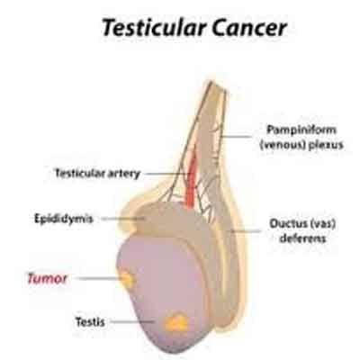 Cancer test testicular How to