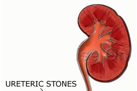 Alpha blockers prove beneficial for treatment of larger ureteric stones: meta-analysis