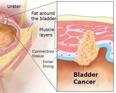 Bladder Cancer-Standard Treatment Guidelines