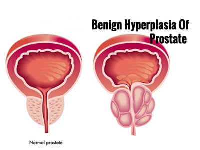 Benign Hyperplasia Of Prostate (BPH)-Standard Treatment Guidelines