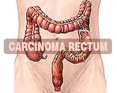 Carcinoma Rectum-Standard Treatment Guidelines