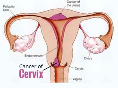 Cancer cervix-Standard Treatment Guidelines