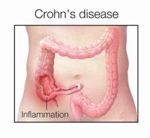 Ustekinumab Reduces Crohns Disease Related Hospitalization and Surgery